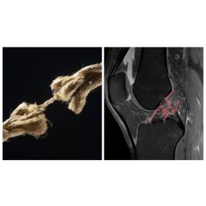 Read more about the article RMN genunchi: Diagnostica Leziunile Ortopedice și Sportive