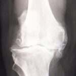 artroza la genunchi